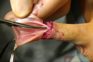 Regierung sieht Beschneidungstourismus-Boom, 70 Prozent votieren für Verstümmelung Rituelle_Beschneidung