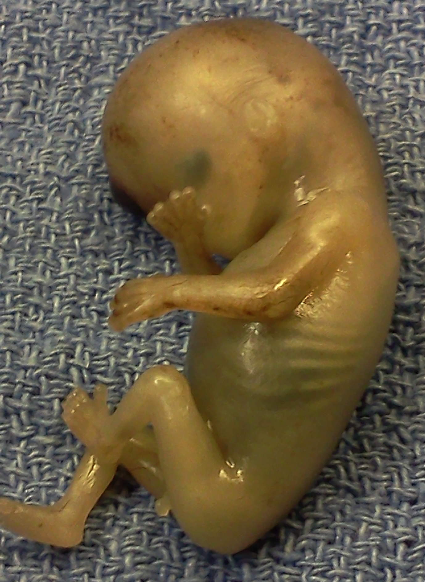 Foetus 11 Woche totgeburt abtreibung selektion aussortiert ausschuss menschenmuell embryo