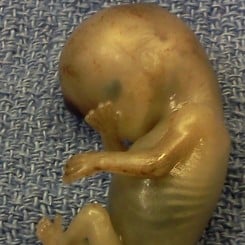 foetus 11 woche totgeburt abtreibung selektion aussortiert ausschuss menschenmuell embryo
